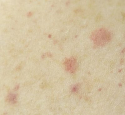 How To Treat Chicken Pox In Ayurved